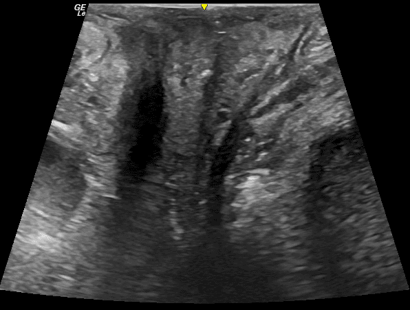 Trans-perineal pelvic floor ultrasound scan