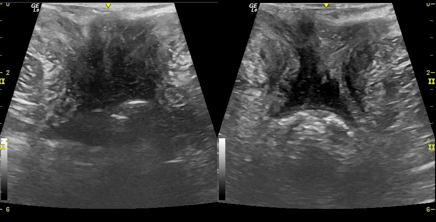 Bilateral pelvic floor ultrasound comparison